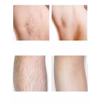 808nm Diode Laser Device - Painless At Home Laser Hair Removal Beauty Equipment