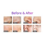 6 in 1 Microdermabrasion Machine - Portable Facial Cleansing Oxygen Jet Peel Beauty Tool