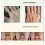 8 in 1 Fraction Plasma - Spot Removal Skin Tightening Face Lift US/IT/ZA Plug