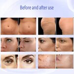 Morpheus8 Fractional Machine - New Arrival High RF Facial Skin Rejuvenation Salon