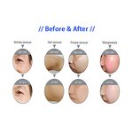 ADG IPL OPT Laser - Skin Rejuvenation Aesthetic Laser Hair Removal Accessories