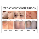 Fractional CO2 Laser Machine - 2025 Portable 10600nm Skin Resurfacing Anti-Aging