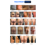 ADG Endospheres Spa Machine - Inner Ball Roller Vacuum Cellulite Remove Pain Relief