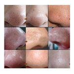 Blackhead Export Liquid - Salon Area Care Pore Cleaning Facial Cleansing Solution