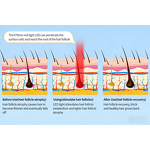 Red Light Hair Care Helmet Manufacturer - CE Approved for Home Hair Growth Treatments