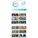 Hair Growth Helmet Manufacturer - Wireless Use LED Light Treatment Red Light Therapy for Home