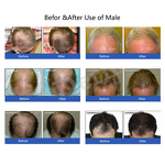 Red Light Hair Care Helmet Manufacturer - CE Approved for Home Hair Growth Treatments