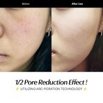 Titanium Derma Roller - 540 Needles Face Rejuvenation Beard Body Stretch Marks