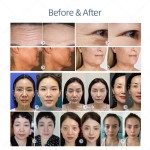皮肤紧致设备源头工厂-2024新款去皱器面部提升紧实橘皮组织颈部