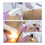 Germany IPL Factory - Xenon Lamp Fast Hair Removal Dpl IPL Photonfacial Machine