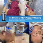 痘痘去除设备源头工厂-博凯3合1点阵微针含射频