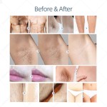 808nm Laser Manufacturer - Portable Hair Remover Machine Bowket Breast Massager for Women