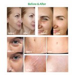 Ultrasound Therapy Manufacturer - Facial Rejuvenation Antiaging Machine with Heat-up Wrinkle Remover