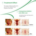 Portable RF Device Manufacturer - Face Lift Vaginal Tightening Beauty Targeted for Virginian Area US ZA UK