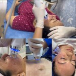 RF Microneedling Manufacturer - Bowket Golden Needle Fractional Radiofrequency Machine for Eye