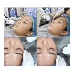 Hydro Vacuum Injection Manufacturer - BOWKET Needle-Free Microneedle Machine for Skin Rejuvenation Whitening