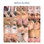 Eyebrow Laser Removal Factory - Bowket Pigment Tattoo Machine for Home Use Skin Tightening Lifting