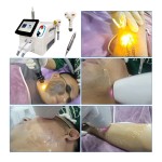 Q Switch Laser Factory - Aesthetics Painless 2 In1 Tattoo Removal 755 808 1064 Diode Laser