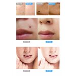 Beauty Pen Manufacturer - OEM Professional Hand-held Laser Plasma for Wart and Mole Removal US Plug