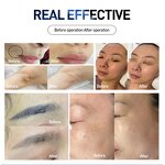 2-in-1 Laser Machine - Professional Hair Tattoo Removal Skin Rejuvenation SPA