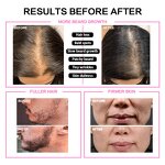 High Frequency Skincare Device - Handheld Facial Wand Treatment EU Plug