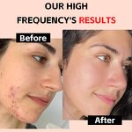 High Frequency Wand Manufacturer - Electrotherapy with 7 Heads for Acne & Fax