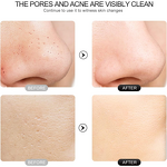 Electric Face Spatula Manufacturer - Pore Cleaner and Skin Scrubber Blackhead Remover