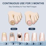 Nail Fungus Therapy Machine - Portable Home Multi-Nail Damaged Yellowed Repair