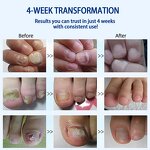 Nail Fungus Drops - Manufacturer 10ML Oregano Tea Tree Finger Toenail Repair