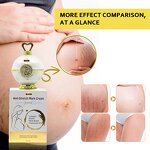 5D Gluta Stretch Mark Cream - Manufacturer Anti Reduce Scar Massage Fast Results