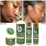 Aloe Vera Toner - Manufacturer OEM Private Label Repair Itching Swelling Acne Scar