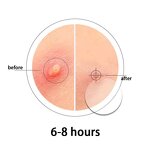 Acne Patch Manufacturer - Dotdot Custom Cute Sticker Hydrocolloid Private Label Healing