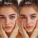 Acne Patches Manufacturer - Transparent Hydrocolloid Organic CE Certified 36 Patches