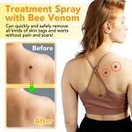 Skin Tag Remover - 60ml Advanced Spray Natural Bee Venom Moles Warts Removal