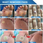 Wart Remover Pad - Wholesale 24 Count Corn Callus Feet Hand Skin Care Solution