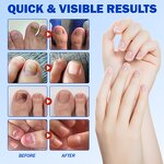 Nail Patch - SEFUDUN Anti Fungal Overnight Repair Brittle Thickening Nails