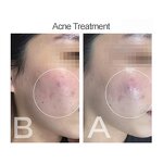 Cold Plasma Machine Manufacturer - B Plasma Beauty Equipment for Acne & Firming