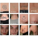 Picosecond Laser Machine Manufacturer - Professional 1320nm/1064nm/532nm Q-switched ND YAG