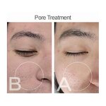 Cold Plasma Machine Manufacturer - B Plasma Beauty Equipment for Acne & Firming