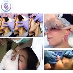 PDO Thread Lift - Manufacturer - Korean Medical 30g Blunt Needle for Eyes