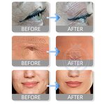 Plasma Pen - Manufacturer - Eyebrow Embroidery Tattoo Removal Korea Large Area