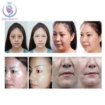 Dr Pen Ultima A6 - Manufacturer - Dermaroller Micro Needle Cartridges 12-36 Pin