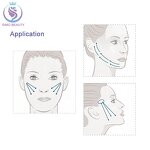 Nasal Thread - Manufacturer - ISO13485 50mm/70mm Deviated Septum Correction