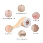 Silicone Scar Patch - Manufacturer - Reusable Water-resistant Hypoallergenic Acne