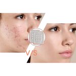Acne Patches - Manufacturer - Hydrocolloid Dissolving Microcrystal Pimple Zits