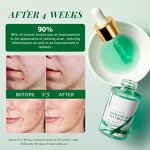 Tea Tree Oil - Manufacturer - Salicylic Acid Peeling Blackhead Remover Anti Acne Brightening