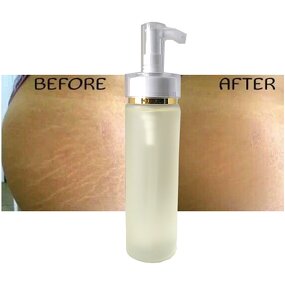 Stretch Marks Oil Manufacturer - Whitens Naturally for Scars & Marks