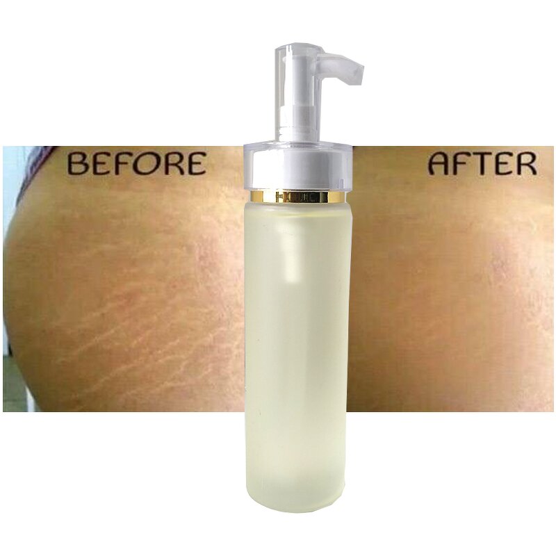 Stretch Marks Oil Manufacturer - Whitens Naturally for Scars & Marks