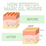 Stretch Marks Oil Manufacturer - Whitens Naturally for Scars & Marks