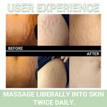 Stretch Marks Oil Manufacturer - Whitens Naturally for Scars & Marks